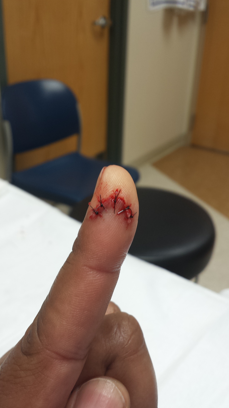 ...do you really want to see the “before” picture? I tried to get the P.A. to draw 2 dots above the stitches to make my finger look like it has a sad face. No luck.